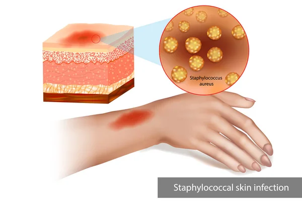 Infección estafilocócica de la piel o infección por estafilococo. Infección bacteriana superpuesta Celulitis cutánea. — Vector de stock