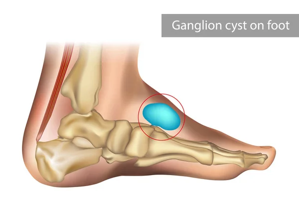 Medical vector illustration of ganglion foot cyst with bones. Big ganglion cysts,a sac of jelly like fluid,is on the foot of man put — стоковый вектор