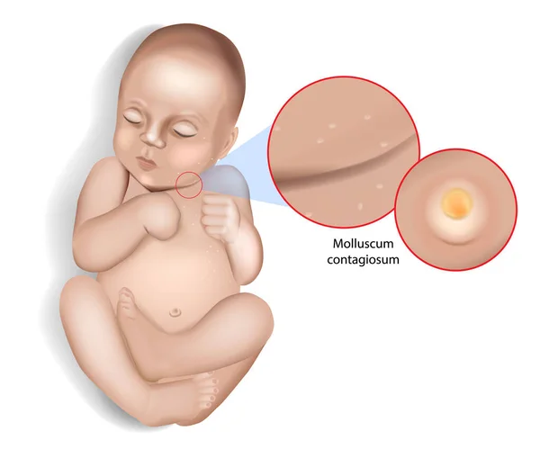 Molluscum contagiosum virus infection. Water warts. Molluscum contagiosum on the skin of an infant — Stock vektor