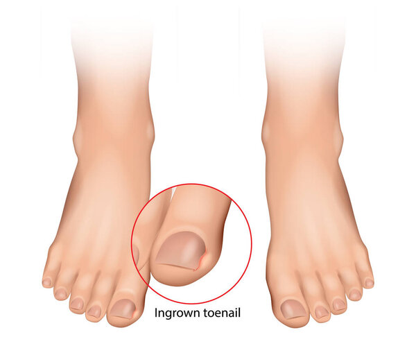 Ingrown toenail or onychocryptosis that occurs when the nail edge grows into the periungual dermis. Nail disease. Vector illustration.