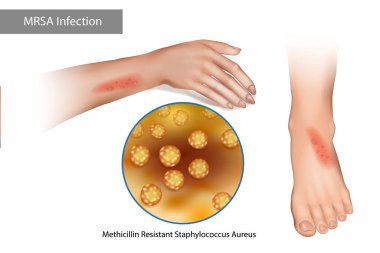 MRSA Süperböcek Enfeksiyonu. Methicillin dirençli Staphylococcus Aureus. Stafilokok kaynaklı kol ve bacaklarda kızarıklıklar var.