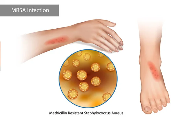 Инфекция супербактерии MRSA. Метициллин устойчивый к стафилококку Aureus. Сыпь на руках и ногах, вызванная стафилококком — стоковый вектор