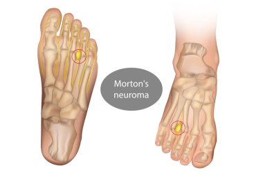 Morton nöromu, Mortonlar metatarsalji, metatarsal nöroma ve metatarsal uzay nöromu..