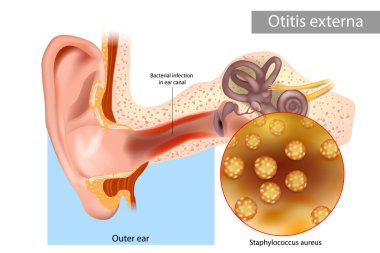 Otitis externa also called swimmers ear. Inflammation ear canal of the Staphylococcus aureus.. Human Ear Anatomy