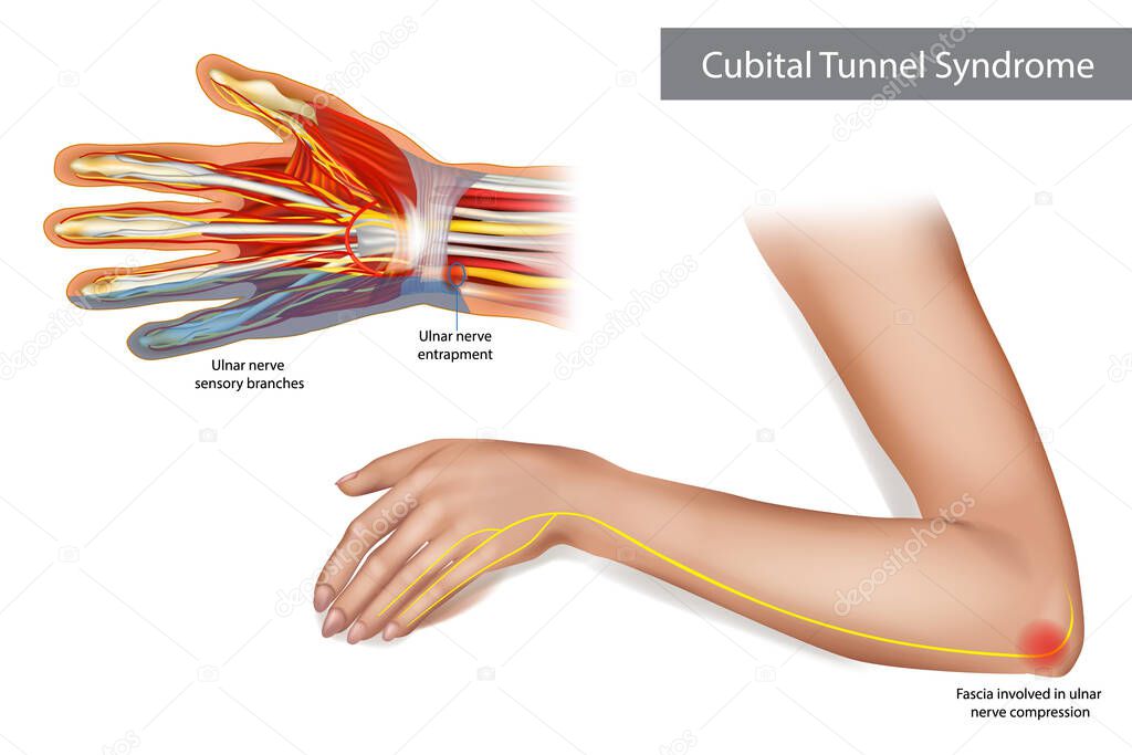Medical illustration to explain Cubital tunnel syndrome. Ulnar nerve entrapment. Fascia involved in ulnar nerve compression.