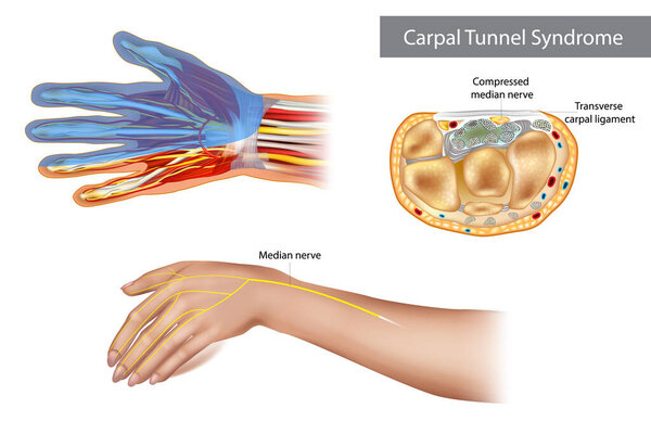 Carpal tunnel syndrome. Compressed median nerve. Anatomy of the carpal tunnel, showing the median nerve.