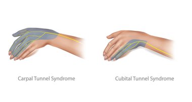Cubital ve Karpal Tünel Sendromu 'nun tıbbi çizimi. Sıkıştırılmış Medya ve Ulnar siniri.