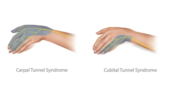 Illustrazione medica della Sindrome del Tunnel Cubitale e Carpale. Nervo mediano compresso e nervo ulnare. — Vettoriale Stock