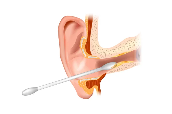 Ilustração do canal auditivo sendo limpo com um cotonete. Secção da orelha com o cerúmen. Removendo a cera de ouvido e maneira errada de usar algodão cotonete. — Vetor de Stock