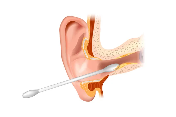 Ilustración del canal auditivo que se limpia con un hisopo de algodón. Sección del oído con el cerumen. Extirpar la cera y la forma incorrecta de usar un hisopo de algodón. — Archivo Imágenes Vectoriales