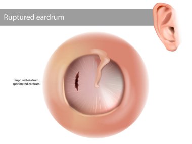 Ruptured eardrum or perforated eardrum. Tympanic membrane perforation. clipart