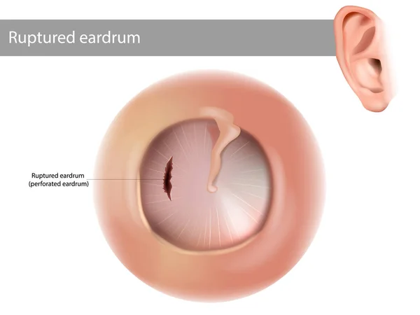 Ruptured eardrum or perforated eardrum. Tympanic membrane perforation. — Stock Vector