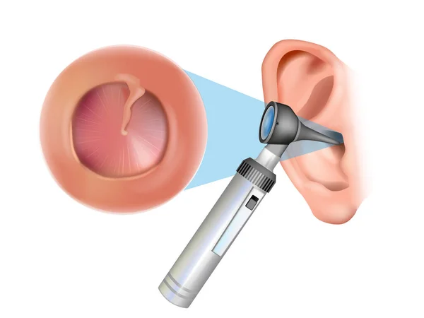 Examen de oído con otoscopio. Otitis media con derrame: otitis media serosa, otitis media secretora. Inflamación del tímpano. Otorrinolaringología — Vector de stock