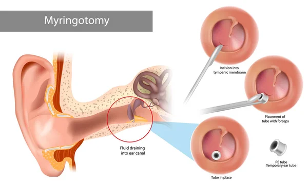 Paracentèse ou myringotomie. Incision dans la membrane tympanique. Procédure chirurgicale impliquant une ponction de la membrane tympanique afin d'évacuer l'oreille moyenne de la sécrétion pathologique. — Image vectorielle