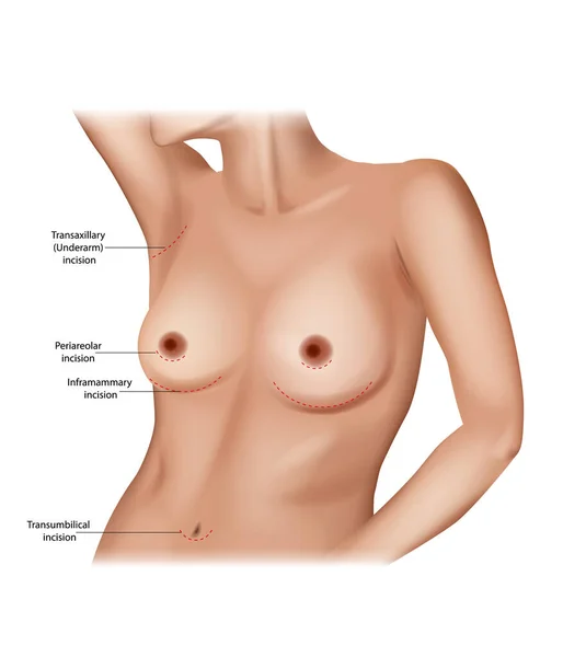 Colocación de incisión de aumento de senos. Puntos de incisión en la cirugía de implantes mamarios. Incisión transumbilical, inframamamaria, periareolar y transaxilar. — Vector de stock
