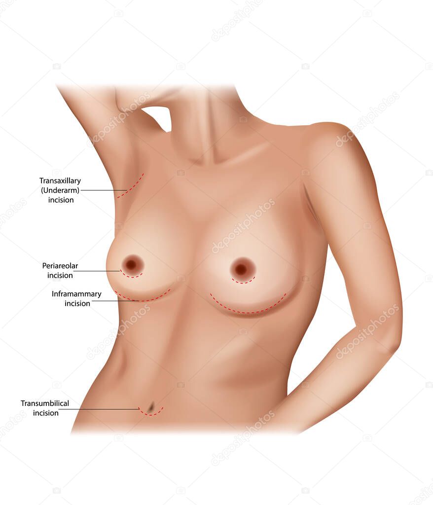 Breast Augmentation Incision Placement. Incision points in breast implant surgery. Transumbilical, Inframammary, Periareolar and Transaxillary incision.