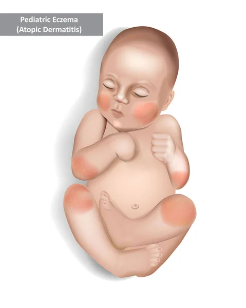 Eczema pediatrico o Dermatite atopica in neonati e bambini. — Vettoriale Stock