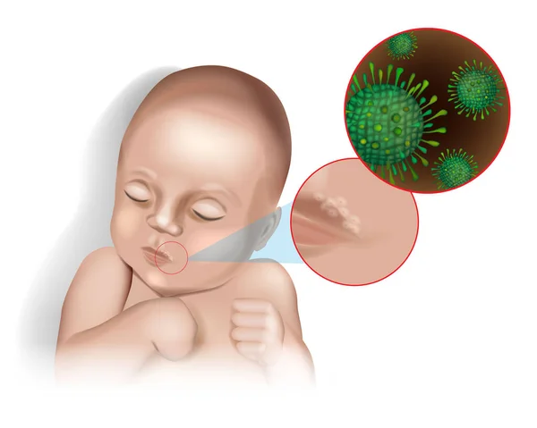 어린이의 급성 포진 구염 (Acute herpetic stomatitis) 의 입술에 있는 포진 바이러스의 벡터 그림. 전염병 헤르페스 심플렉스 바이러스. — 스톡 벡터