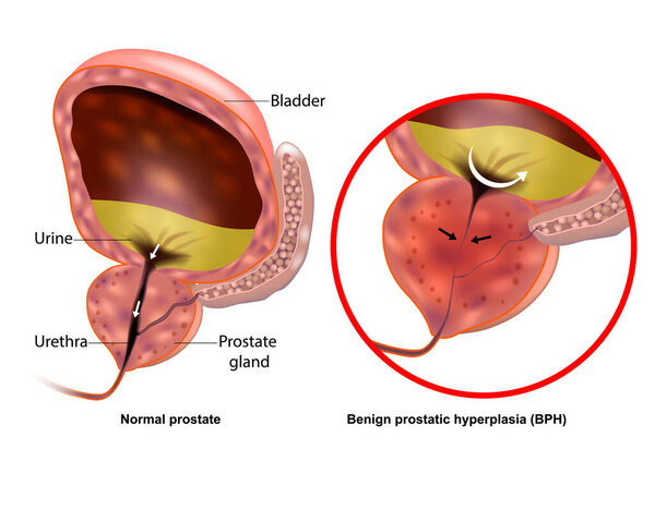 Medical illustration showing Benign prostatic hyperplasia BPH and Normal prostate. Prostate gland enlargement