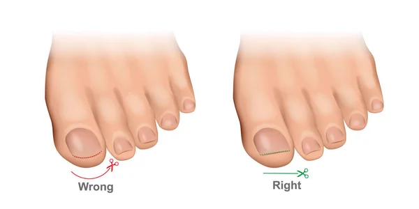 วิธีการตัดเล็บเท้าภาพเวกเตอร์อย่างถูกต้อง การตัดเล็บที่เหมาะสมและไม่เหมาะสม เล็บเท้าหัก . — ภาพเวกเตอร์สต็อก