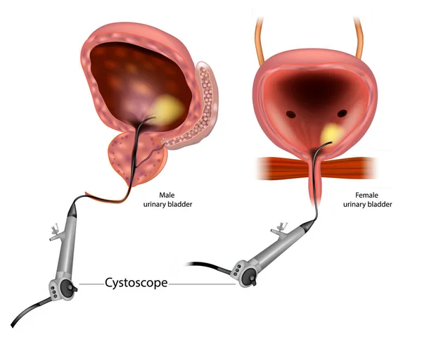 Diagram som visar en flexibel cystoskopi för en man och en kvinna. Anatomi Man och kvinna urinblåsa. — Stock vektor
