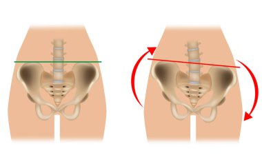 Pelvik çarpıtma karşılaştırması. Leğen kemiği normal ve pelvis zedelenmesi var. Pelvik Torsiyon olarak da bilinen bir Twisted Pelvis.