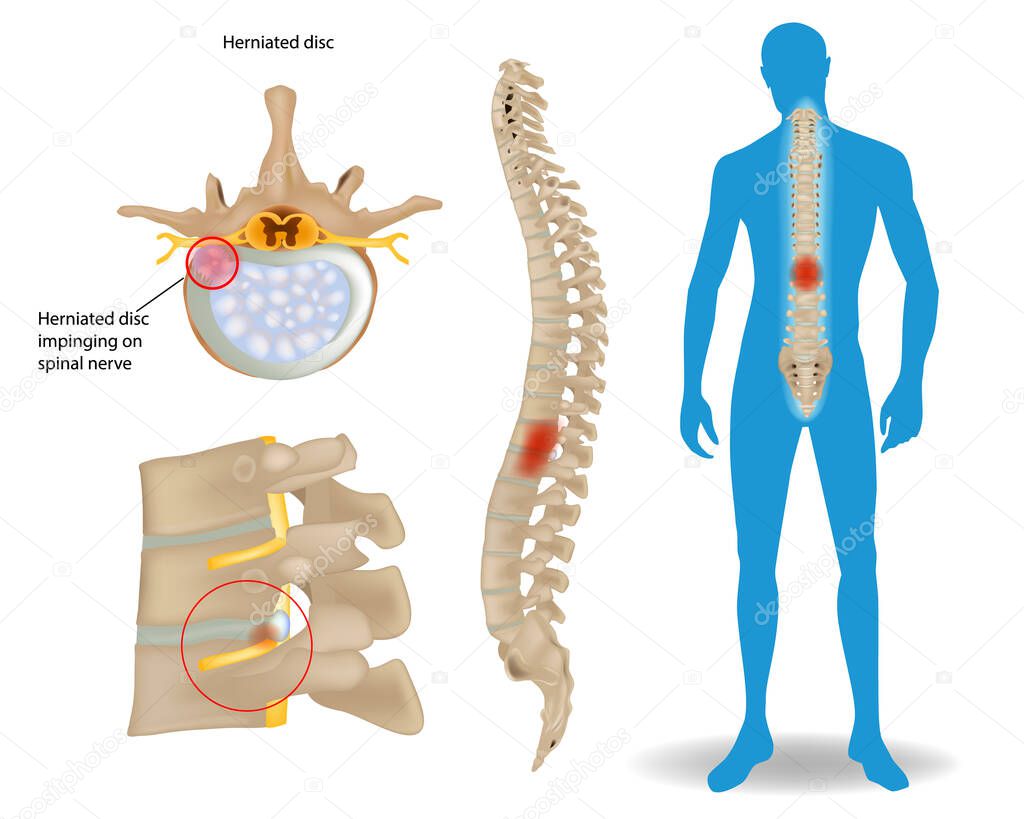 Spinal Disc Herniation. Back Pain Human. Spinal Cord Compression. Bulging disc. Orthopaedic