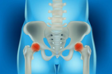 Bones of the pelvis and hip, human anatomy, femur bone joint pain, X ray of the hip joint and femur. Osteonecrosis of the Hip. clipart