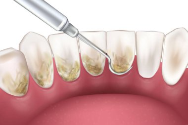 Periodontal Scaling and Root Planing. Oral hygiene and conventional periodontal therapy. Medically accurate of human teeth cleaning treatment. Dental scale.
