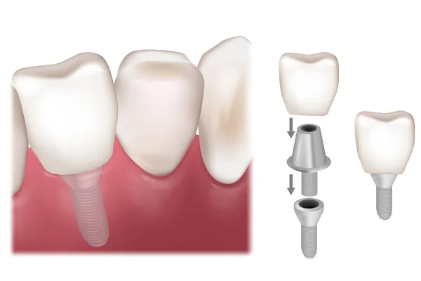 Οδοντιατρική Αποκατάσταση Εμφυτευμάτων Προκαταρκτική Τοποθέτηση Της Στεφάνης Του Δοντιού Πάνω — Διανυσματικό Αρχείο