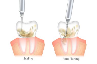 Difference of the Periodontal Scaling and Root Planing. Oral hygiene and conventional periodontal therapy. Medically accurate of human teeth cleaning treatment. Dental scale.