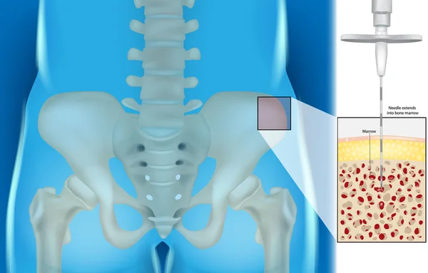 Bone Marrow Aspiration Biopsy Illustration Needle Extends Bone Marrow Hematology — Stockvektor