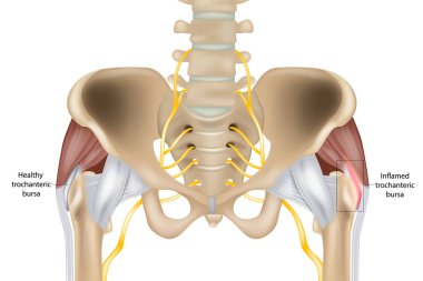 Hip Trochanteric bursitis is inflammation of the bursa. Illustration of the Healthy and inflamed trochanteric bursa. Greater trochanteric pain syndrome.
