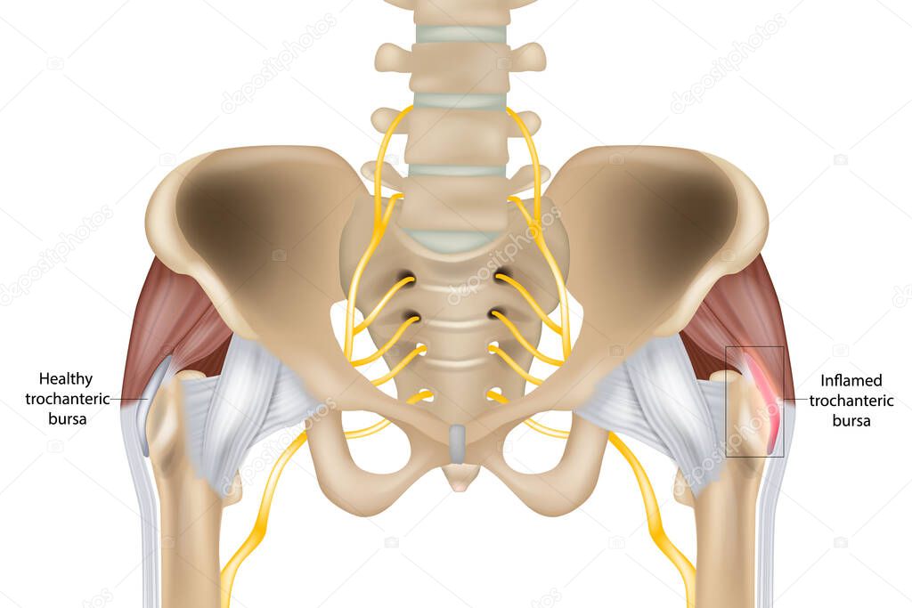 Hip Trochanteric bursitis is inflammation of the bursa. Illustration of the Healthy and inflamed trochanteric bursa. Greater trochanteric pain syndrome.