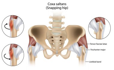 Coxa Saltans or Snapping Hip Snapping Hip Syndrome also referred to as dancer hip. Trochanter major, Tensor fasciae latae and Liotibial band