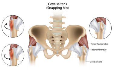 Coxa Saltans or Snapping Hip Snapping Hip Syndrome also referred to as dancer hip. Trochanter major, Tensor fasciae latae and Liotibial band clipart