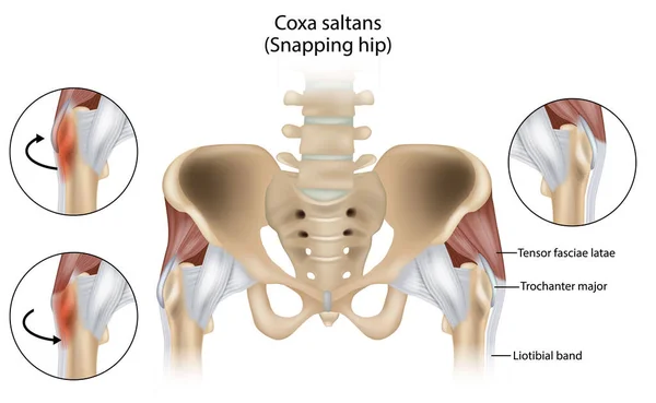 Coxa Saltans Snapping Hip Snapping Hip Syndrome Also Referred Dancer — Stock Vector