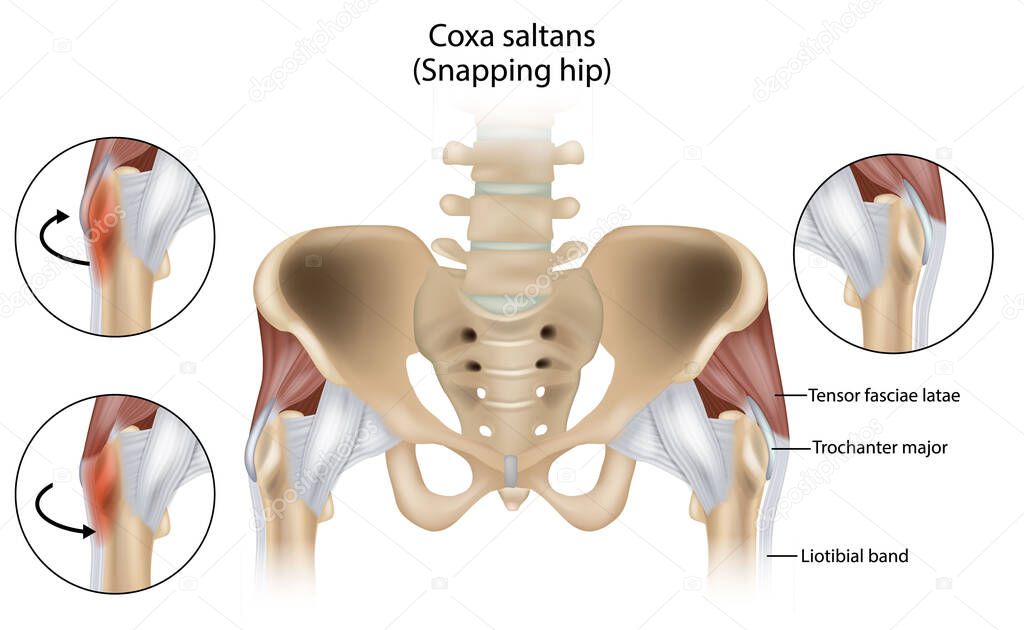 Coxa Saltans or Snapping Hip Snapping Hip Syndrome also referred to as dancer hip. Trochanter major, Tensor fasciae latae and Liotibial band