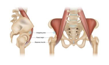 Internal snapping hip Syndrome. Psoas major, Iliopsoas muscle and Snapping area. Vector clipart