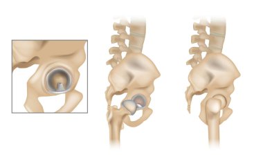 Kalça ve Asetabular Labrum 'un Anatomisi. Ligamentum teres ve eklemik kıkırdak. Sağ kalçasında kalça kemiği alınmış yan görünüm.