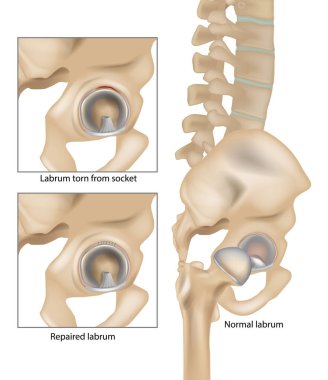 Hip Labral Tears. Labrum torn from socket and Repaired labrum. Surgery for Repairing a Torn Hip Labral. Vector clipart