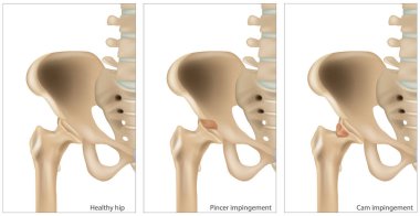Medical illustration of the Femoroacetabular Impingement. Different of the Cam impingement and Pincer impingement. Healthy hip clipart