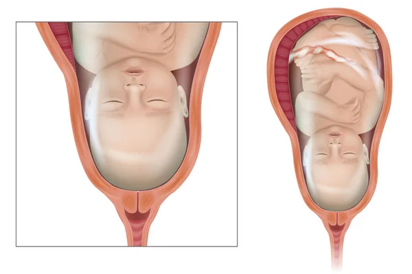 子宮内の赤ちゃんの詳細な医療イラスト ウテロの胎児 — ストックベクタ