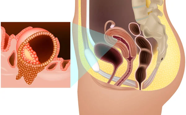 Implantasi Fertilisasi Ovum Yang Dibuahi Rahim Embrio Manusia Yang Ditanamkan - Stok Vektor