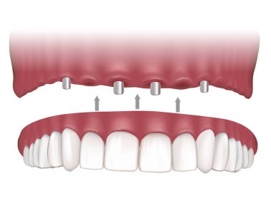 Maxillary Implant Destekli Sabit Protez. Maxillary protezleri dört implantla destekleniyor. Dört diş implantında da prosedür.