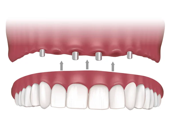 Maxillary Implant Υποστηριγμένη Σταθερή Πρόθεση Μαξοφαρμακευτική Υπεροδοντοστοιχία Τέσσερα Εμφυτεύματα Διαδικασία — Διανυσματικό Αρχείο