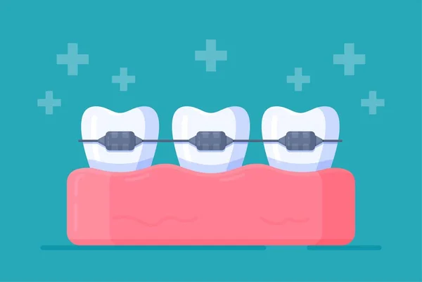 Ilustração Vetorial Aparelho Aparelhos Nos Dentes Isolados Fundo Azul Alinhamento — Vetor de Stock