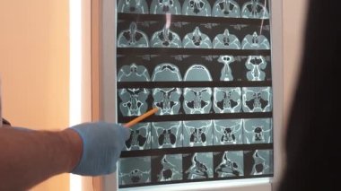 Doktor kalemle gösterilen hesaplanmış tomografi sonuçlarını gösterdi