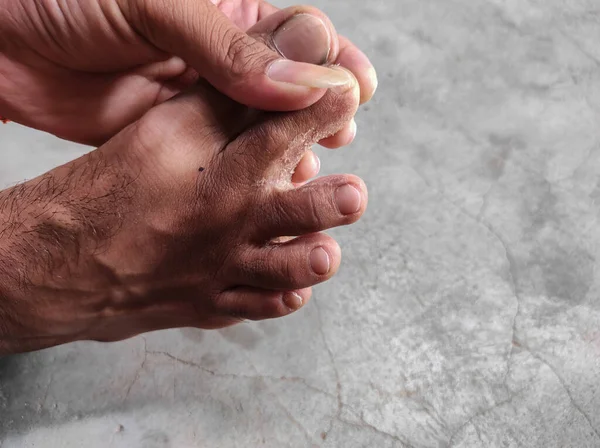 Egy Közeli Felvétel Bőr Lehámlásáról Lábujjakon — Stock Fotó