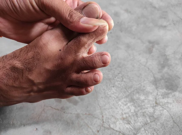 Egy Közeli Felvétel Bőr Lehámlásáról Lábujjakon — Stock Fotó